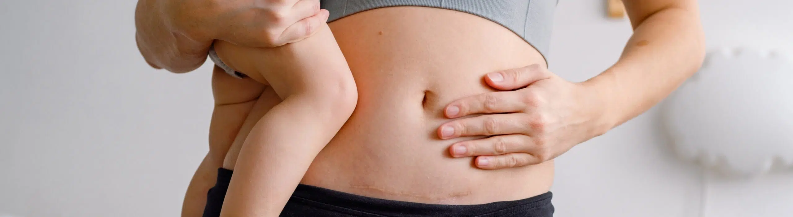 Abdominoplastie apres grossesse