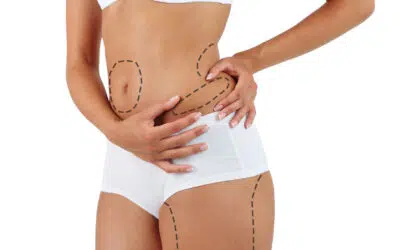 récupération liposuccion