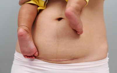 Abdominoplastie après césarienne ce qu il faut savoir | Dr Runge | Paris 7 et Paris 15