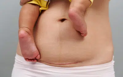 Abdominoplastie après césarienne ce qu il faut savoir | Dr Runge | Paris 7 et Paris 15